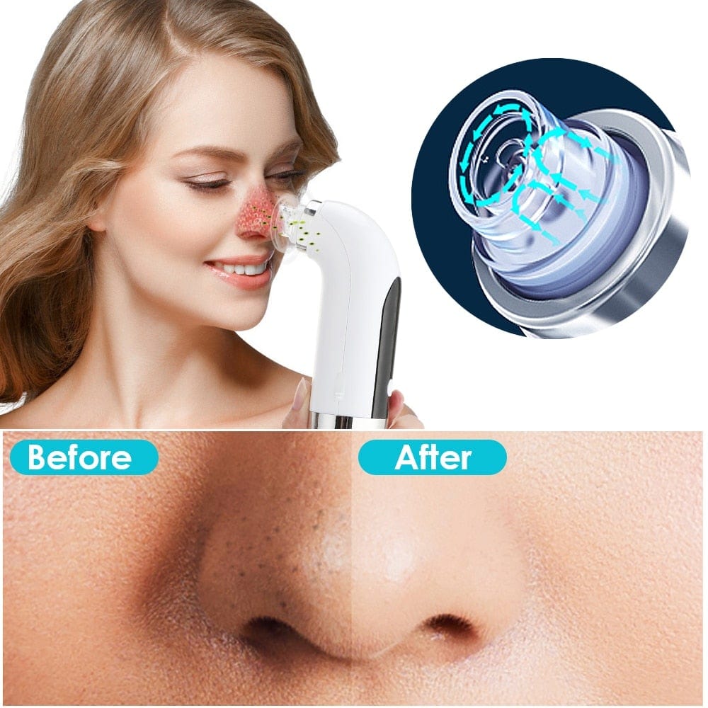 Blackhead Remover Pore Cleaner Vacuum Suction Acne Remover Pimple Black Dot Removal Facial Cleaning Beauty Tools Face Skin Care - wirbe-welt.shop